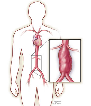 Abdominal Aortic Aneurysm