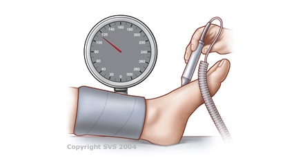 Ankle-Brachial Index or ABI Test