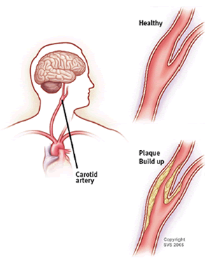 Carotid Artery Disease