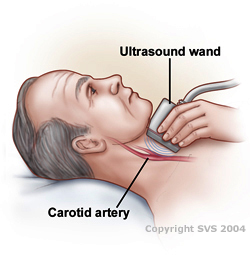 Carotid Duplex