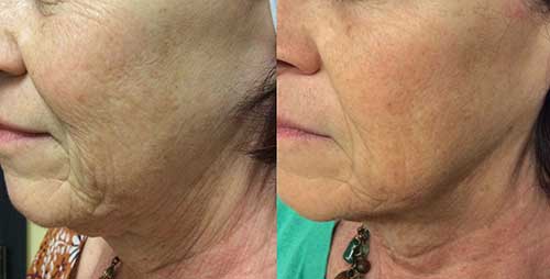 Dermal Remodeling - Secret Radio Frequency Microneedling - Secret Pro