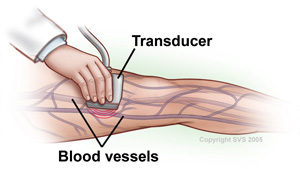 Duplex Ultrasound