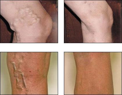 Endovenous Laser Treatment