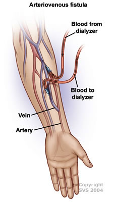 Kidney Disease Dialysis Access