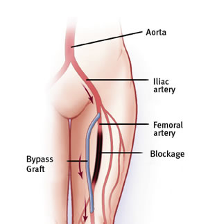 Peripheral Arterial Disease