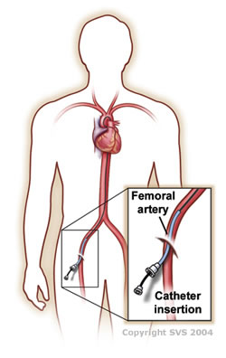 Angiogram