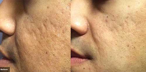 Laser Genesis: Fine Line and Scar Reduction